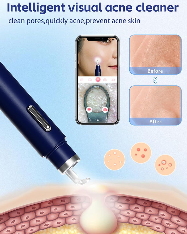 Visual Blackhead Remover with Camera 20X Extractor Kit for iPhone/Android